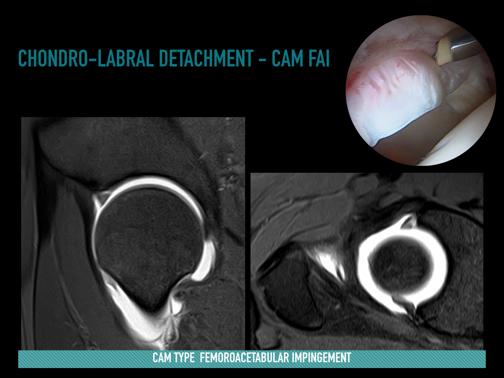 Figure 5 for case Sublabral sulcus